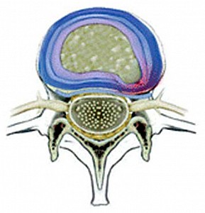 Herniation of intervertebral disc ( Bulging disc)
