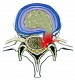 Herniation of intervertebral disc ( herniation of vertebral pulp)