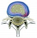 Herniation of intervertebral disc ( Bulging disc)